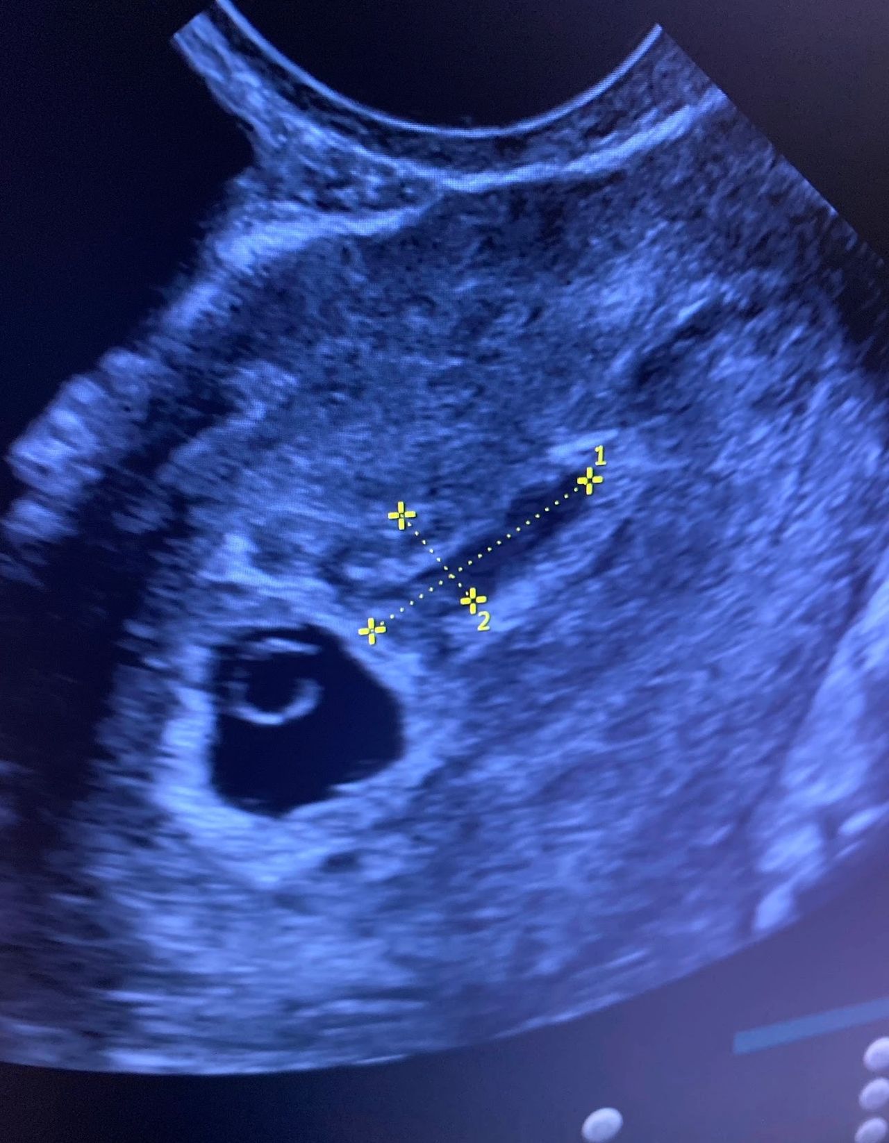 The Biggest Threat In My Pregnancies